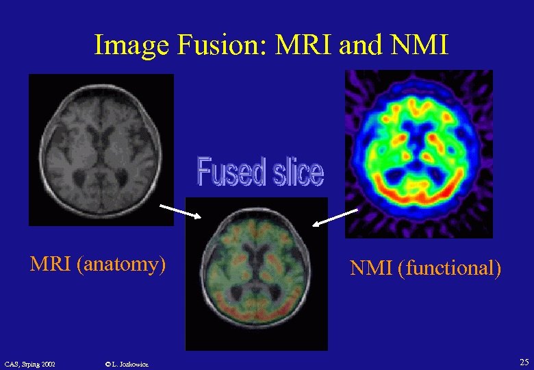 Image Fusion: MRI and NMI MRI (anatomy) CAS, Srping 2002 © L. Joskowicz NMI