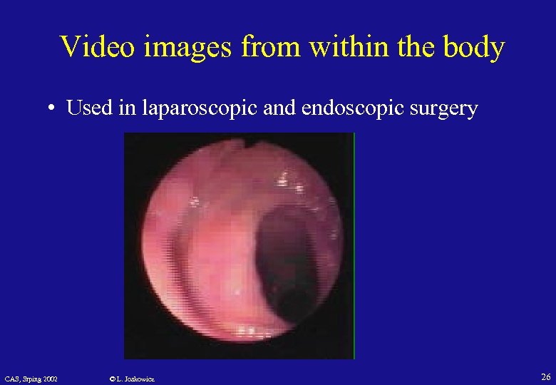 Video images from within the body • Used in laparoscopic and endoscopic surgery CAS,