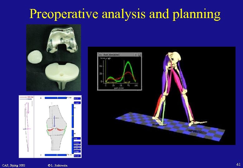 Preoperative analysis and planning CAS, Srping 2002 © L. Joskowicz 41 