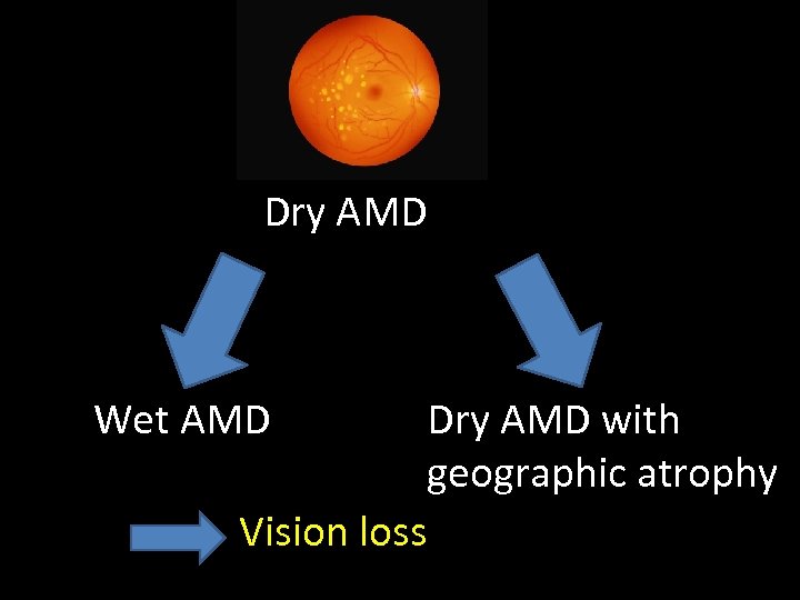 Dry AMD Wet AMD Dry AMD with geographic atrophy Vision loss 