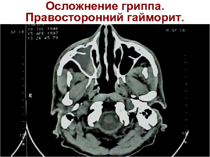 Осложнение гриппа. Правосторонний гайморит. 