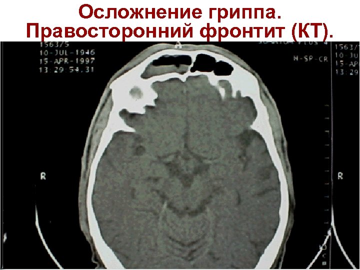 Осложнение гриппа. Правосторонний фронтит (КТ). 