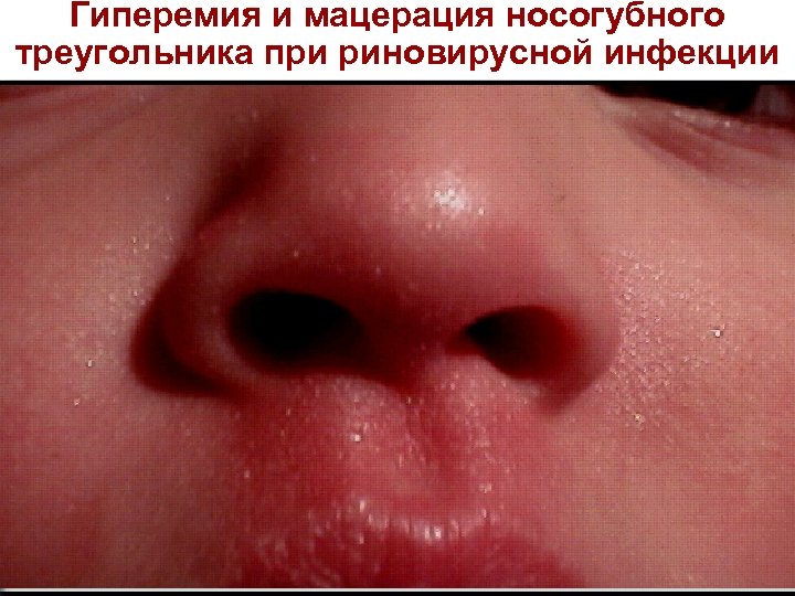 Гиперемия и мацерация носогубного треугольника при риновирусной инфекции 
