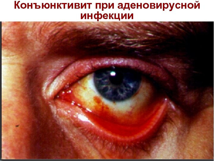 Конъюнктивит при аденовирусной инфекции 