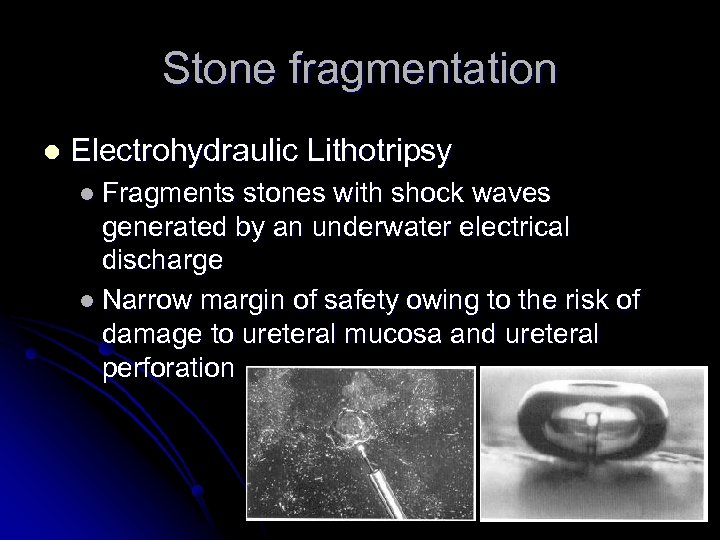 Stone fragmentation l Electrohydraulic Lithotripsy l Fragments stones with shock waves generated by an