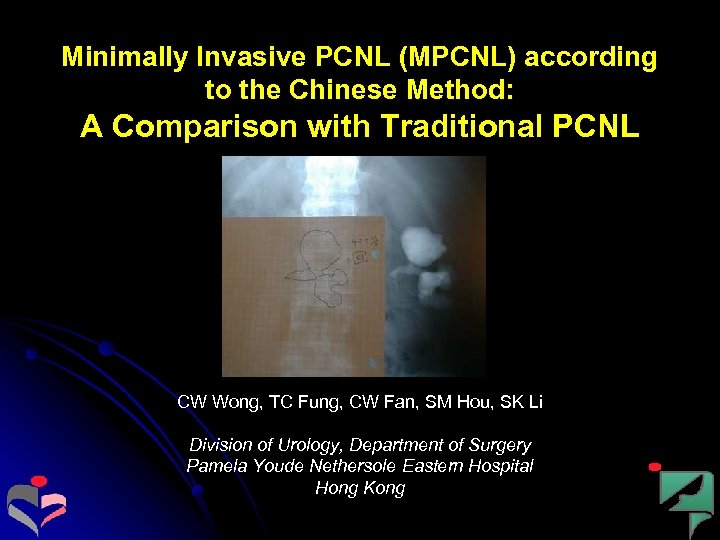 Minimally Invasive PCNL (MPCNL) according to the Chinese Method: A Comparison with Traditional PCNL