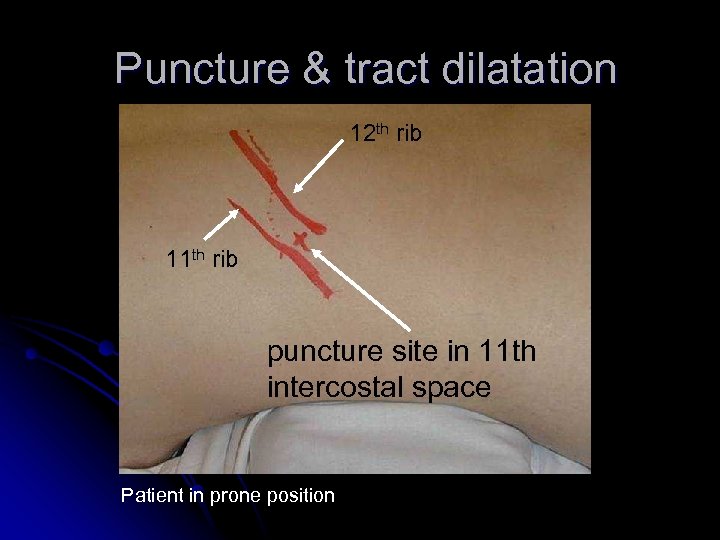 Puncture & tract dilatation 12 th rib 11 th rib puncture site in 11
