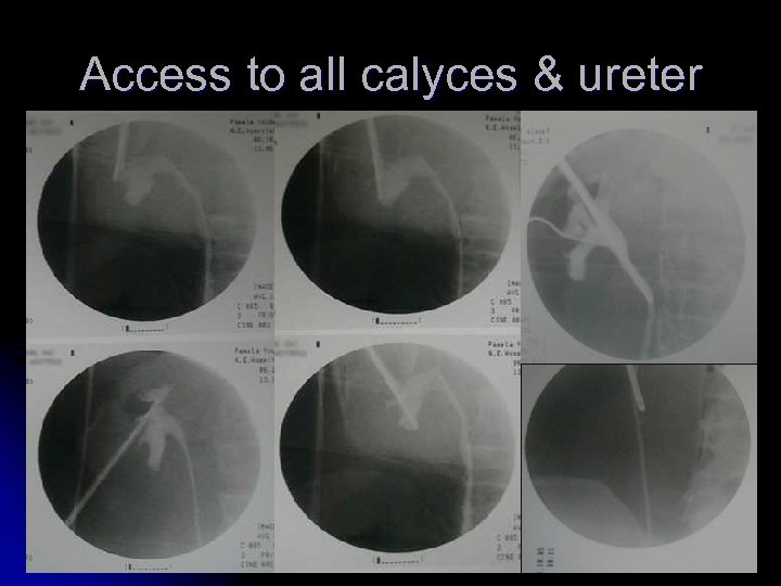 Access to all calyces & ureter 