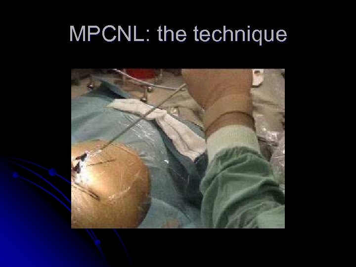 MPCNL: the technique 