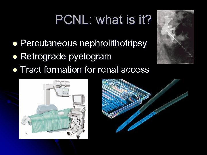 PCNL: what is it? Percutaneous nephrolithotripsy l Retrograde pyelogram l Tract formation for renal