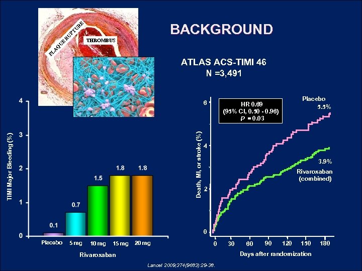 U PT U R E BACKGROUND PL A Q U E R THROMBUS ATLAS