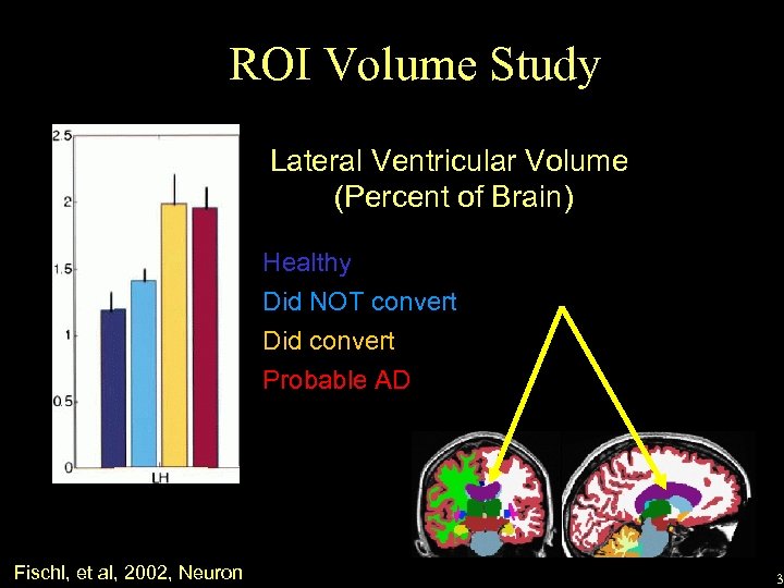 ROI Volume Study Lateral Ventricular Volume (Percent of Brain) Healthy Did NOT convert Did
