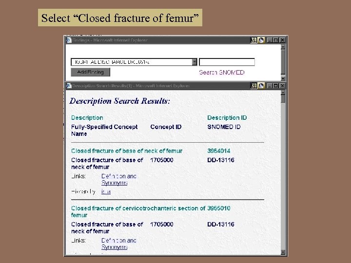 Select “Closed fracture of femur” 