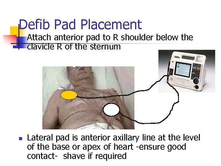 Defib Pad Placement n n Attach anterior pad to R shoulder below the clavicle
