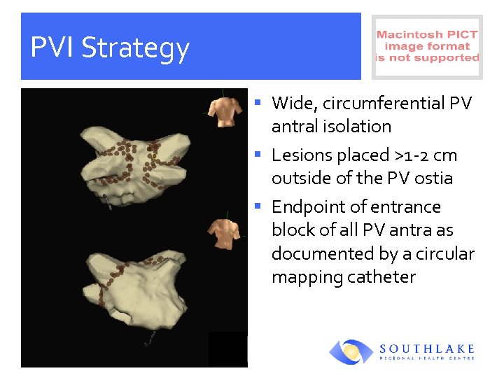 PVI Strategy § Wide, circumferential PV antral isolation § Lesions placed >1 -2 cm