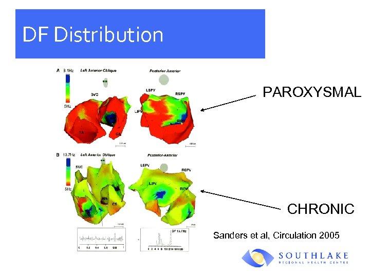 DF Distribution PAROXYSMAL CHRONIC Sanders et al, Circulation 2005 