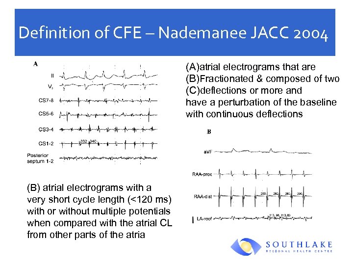 Definition of CFE – Nademanee JACC 2004 (A)atrial electrograms that are (B)Fractionated & composed