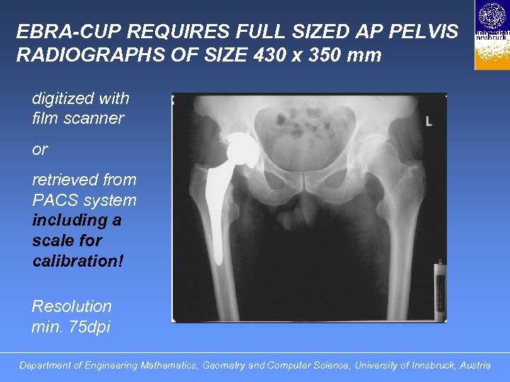 EBRA-CUP REQUIRES FULL SIZED AP PELVIS RADIOGRAPHS OF SIZE 430 x 350 mm digitized