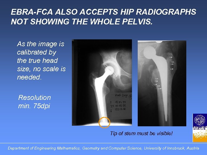 EBRA-FCA ALSO ACCEPTS HIP RADIOGRAPHS NOT SHOWING THE WHOLE PELVIS. As the image is