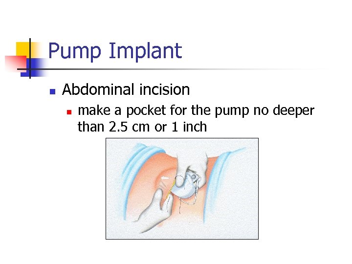 Pump Implant n Abdominal incision n make a pocket for the pump no deeper