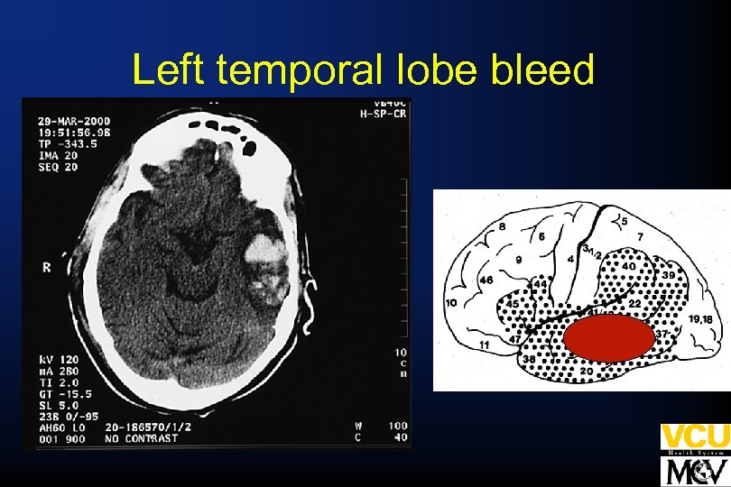 Left temporal lobe bleed 