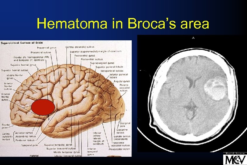 Hematoma in Broca’s area 