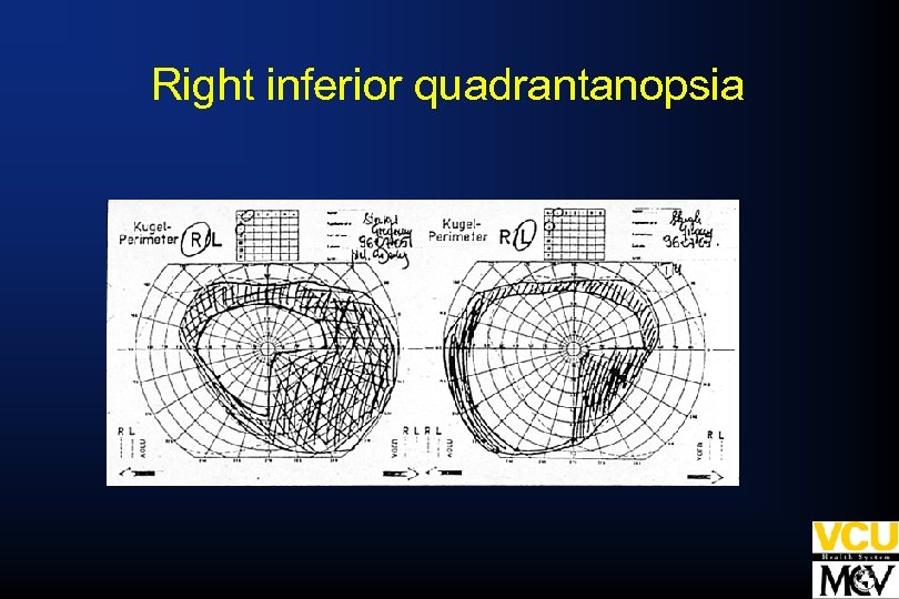 Right inferior quadrantanopsia 
