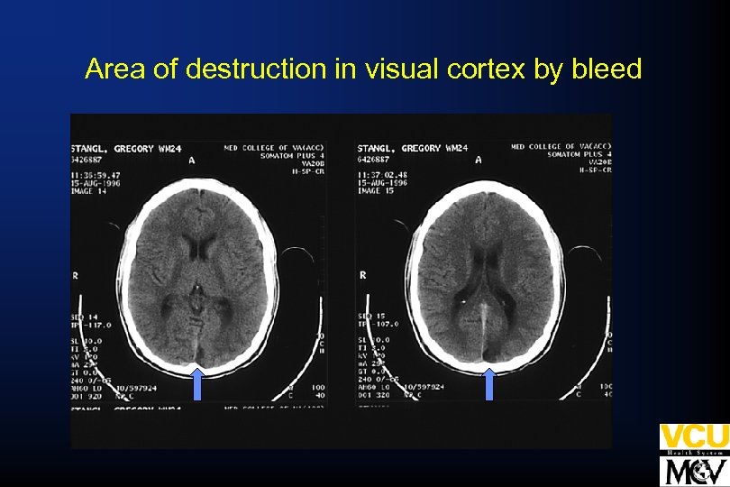 Area of destruction in visual cortex by bleed 