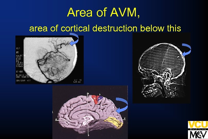 Area of AVM, area of cortical destruction below this 