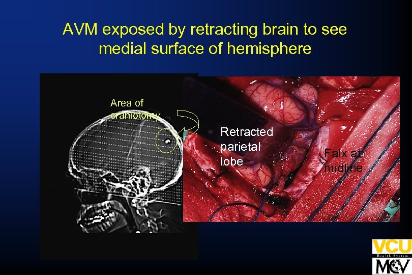 AVM exposed by retracting brain to see medial surface of hemisphere Area of craniotomy