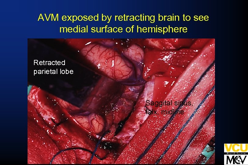 AVM exposed by retracting brain to see medial surface of hemisphere Retracted parietal lobe