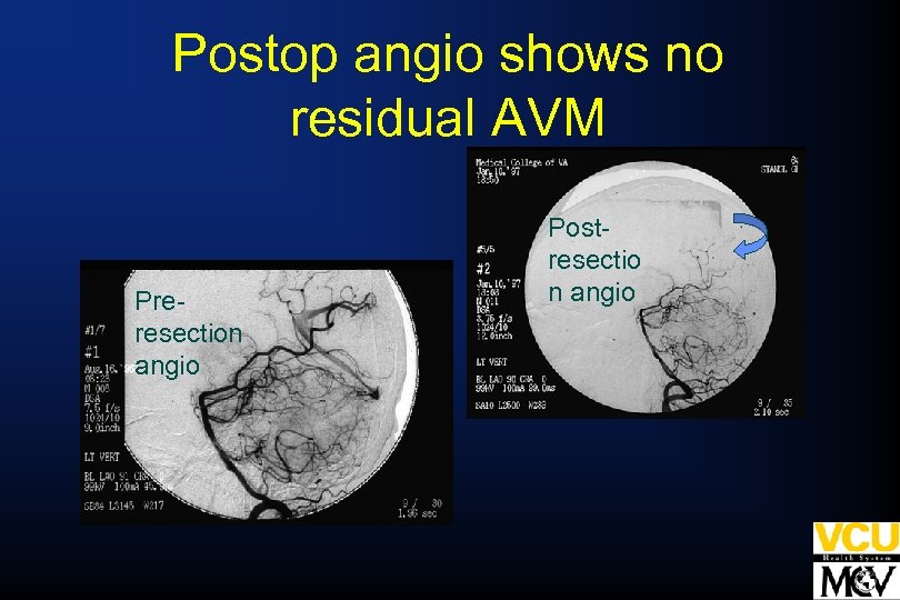 Postop angio shows no residual AVM Preresection angio Postresectio n angio 