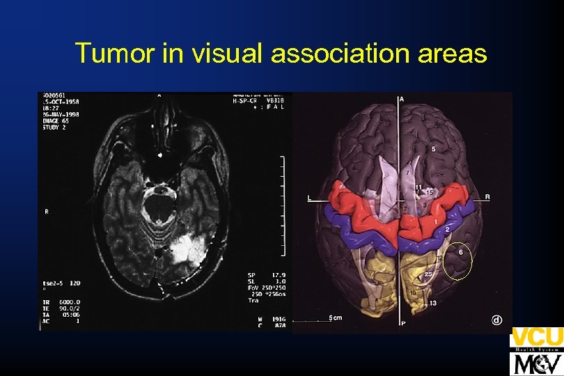 Tumor in visual association areas 