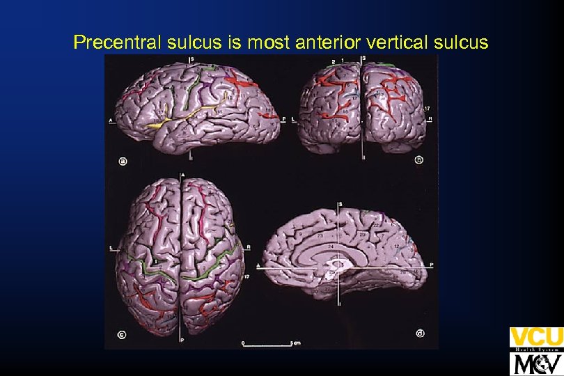 Precentral sulcus is most anterior vertical sulcus 