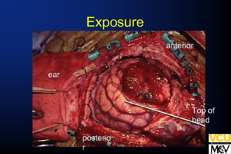 Exposure anterior ear Top of head posterio r 