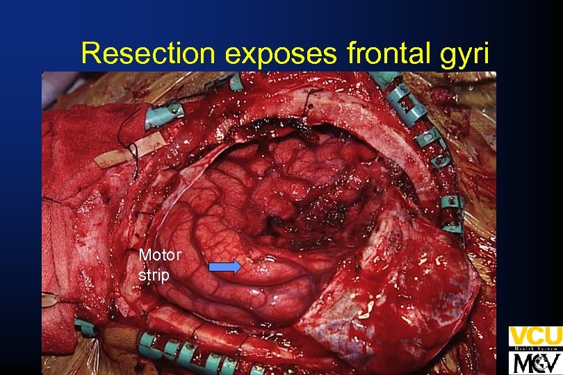  Resection exposes frontal gyri Motor strip 
