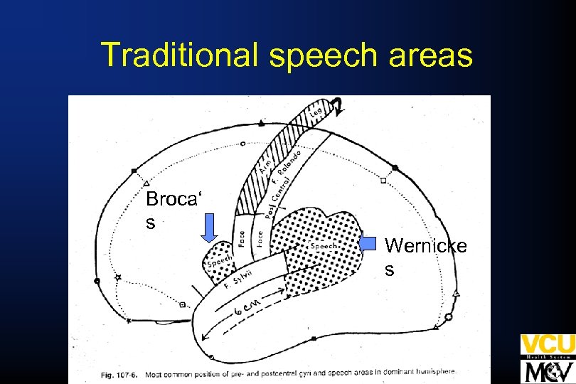 Traditional speech areas Broca‘ s Wernicke s 