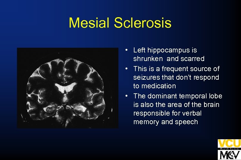 Mesial Sclerosis • Left hippocampus is shrunken and scarred • This is a frequent
