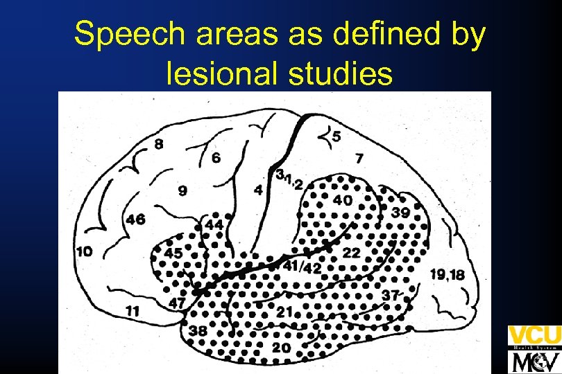 Speech areas as defined by lesional studies 