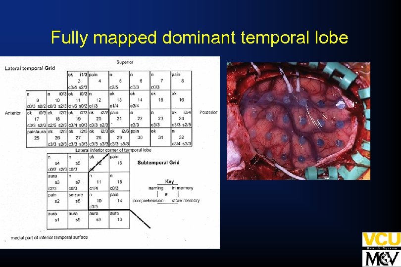 Fully mapped dominant temporal lobe 
