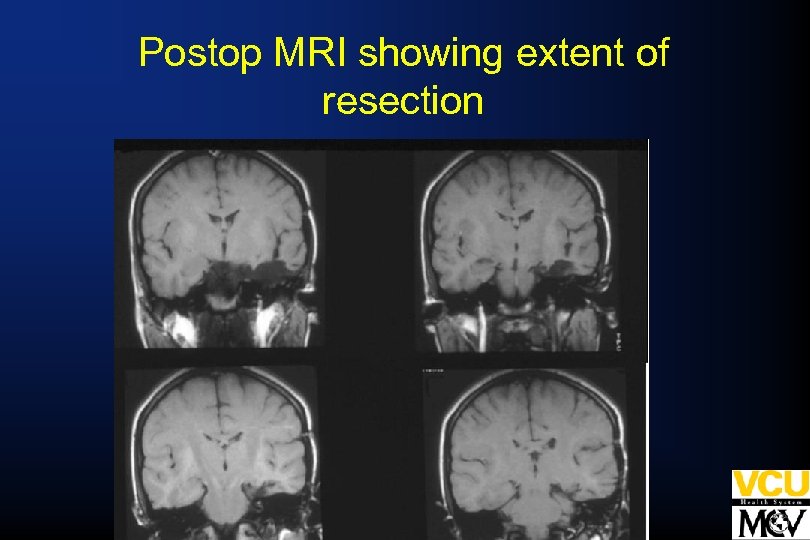Postop MRI showing extent of resection 