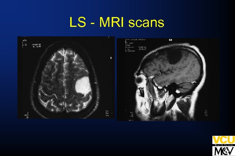 LS - MRI scans 