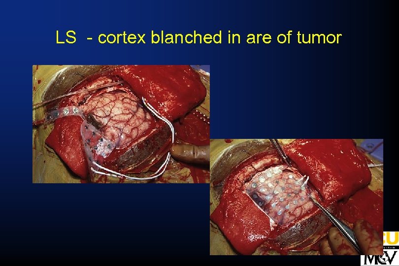 LS - cortex blanched in are of tumor 