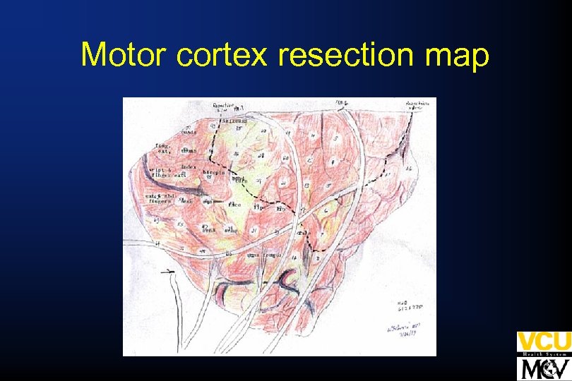 Motor cortex resection map 