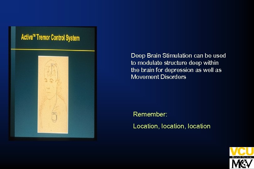 Deep Brain Stimulation can be used to modulate structure deep within the brain for