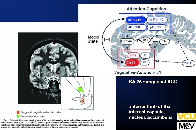 BA 25 subgenual ACC anterior limb of the internal capsule, nucleus accumbens 