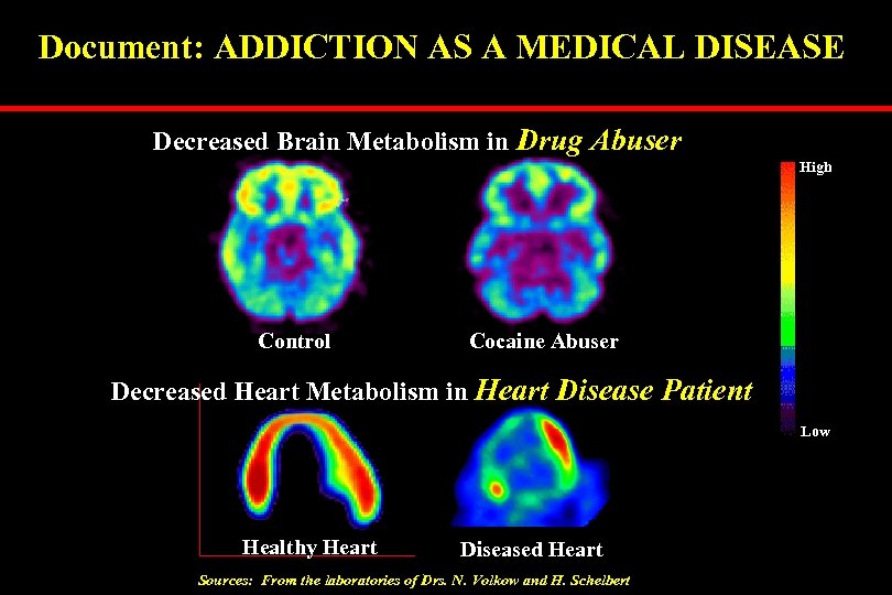 Document: ADDICTION AS A MEDICAL DISEASE Decreased Brain Metabolism in Drug Abuser High Control