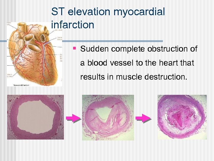 ST elevation myocardial infarction § Sudden complete obstruction of a blood vessel to the