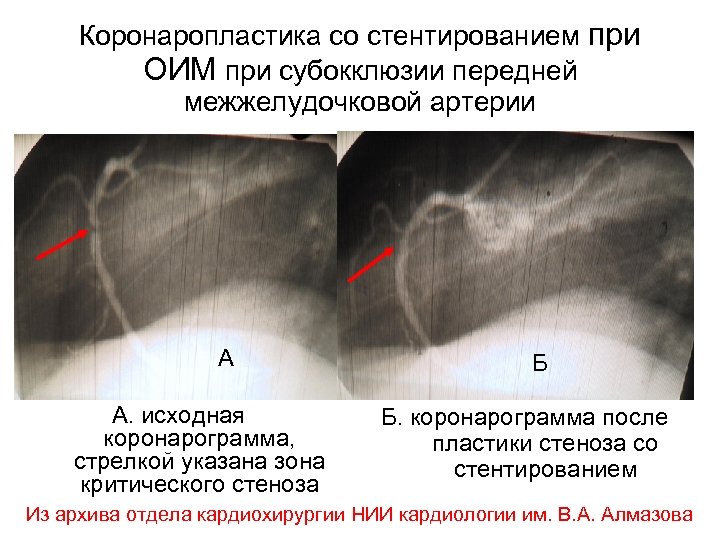 Коронаропластика со стентированием при ОИМ при субокклюзии передней межжелудочковой артерии А А. исходная коронарограмма,