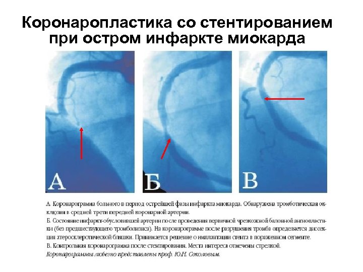 Коронаропластика со стентированием при остром инфаркте миокарда 